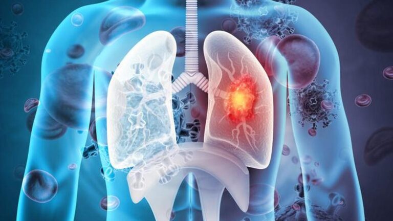 50 yaşın üzerindeki insanlar ve sigara içenler dikkatli olun! Uzmanlar uyarıyor: Çoğunlukla akciğer kanserini öldürüyor –